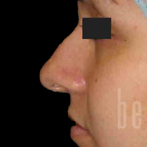 Case--1147 | Before Face