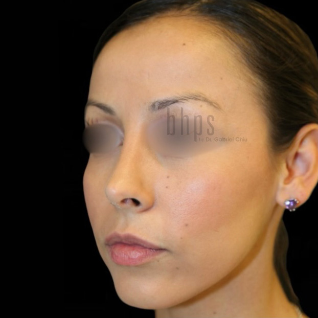 Case--2002 | After Rhinoplasty 2