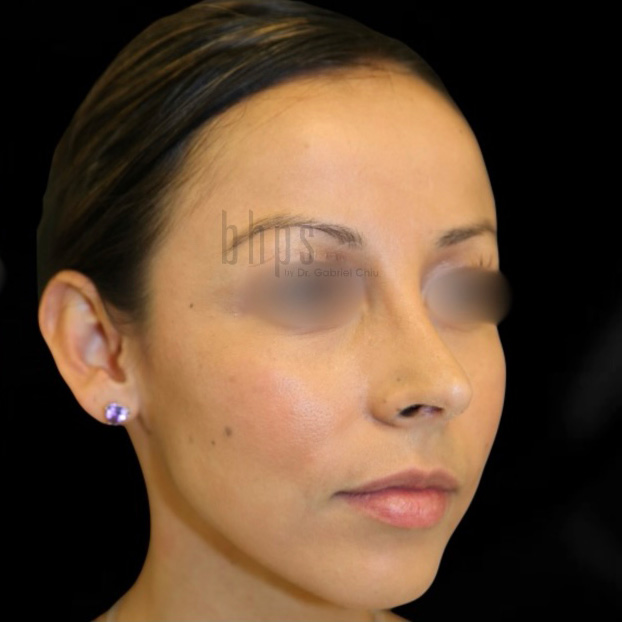 Case--2002 | After Rhinoplasty 3