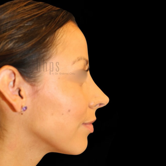 Rhinoplasty Patient After - 2