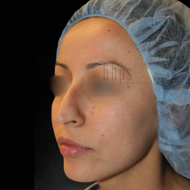 Case--2002 | Before Rhinoplasty 2