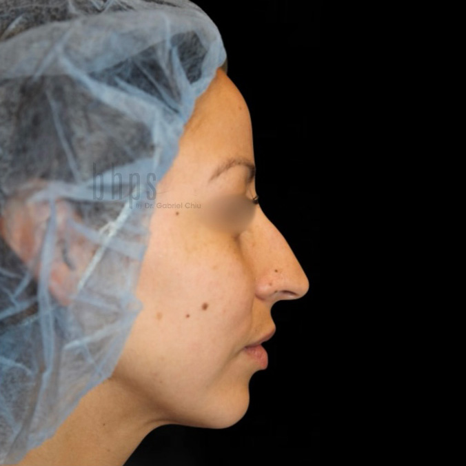 Rhinoplasty Patient Before - 2
