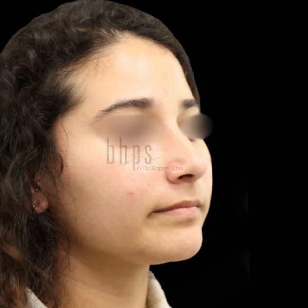 Case--6903 | After Rhinoplasty 2