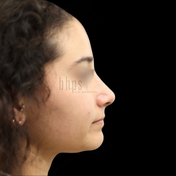 Case--6903 | After Rhinoplasty
