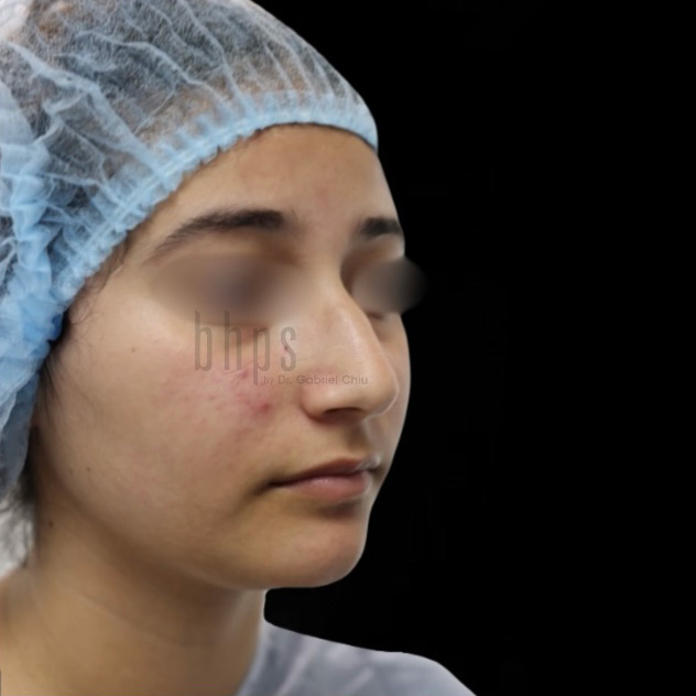 Case--6903 | Before Rhinoplasty 2