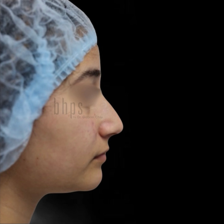 Case--6903 | Before Rhinoplasty