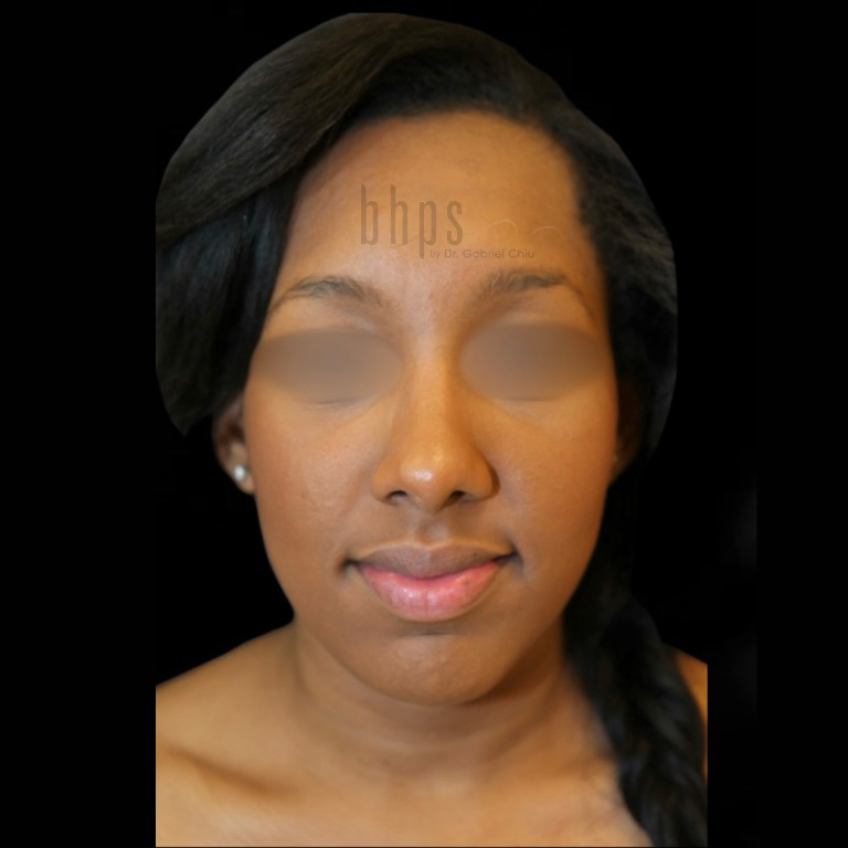 Case--5154 | After Rhinoplasty 2