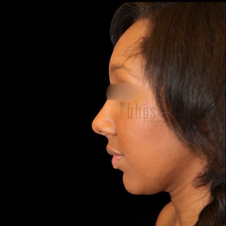 Case--5154 | After Rhinoplasty