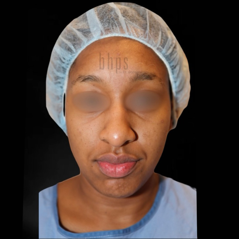 Case--5154 | Before Rhinoplasty 2