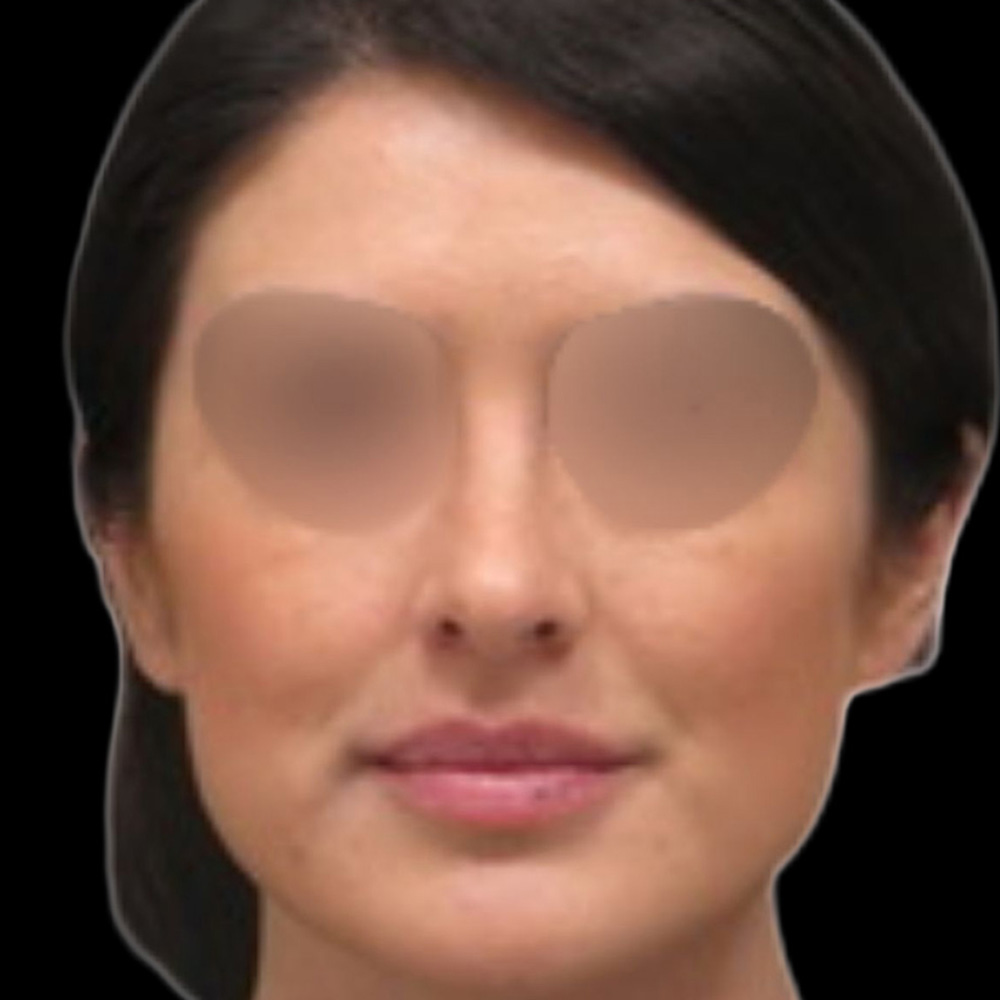 Case--7782 | After Rhinoplasty 2