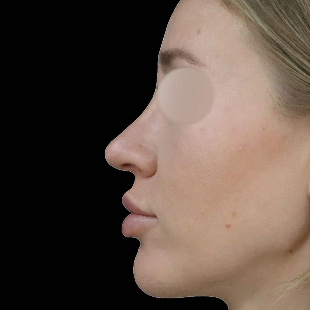 Case--9391 | After Rhinoplasty