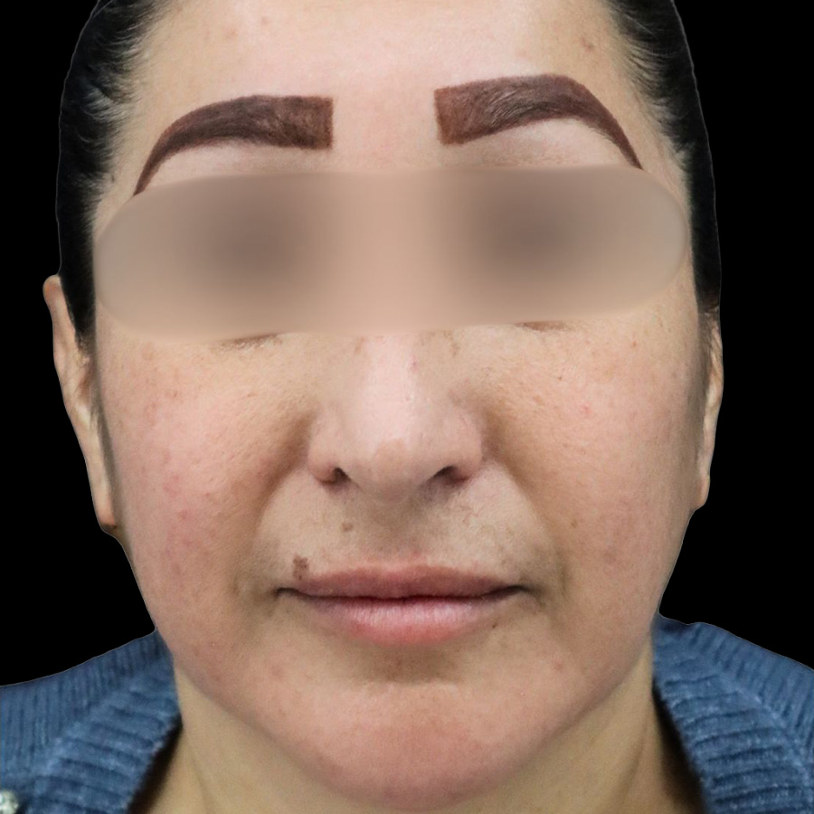 Case--8771 | After Rhinoplasty 2