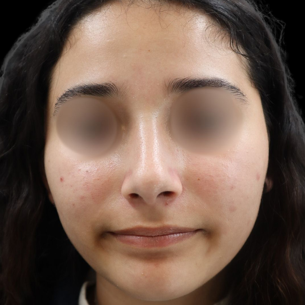 Case--9972 | After Rhinoplasty 2