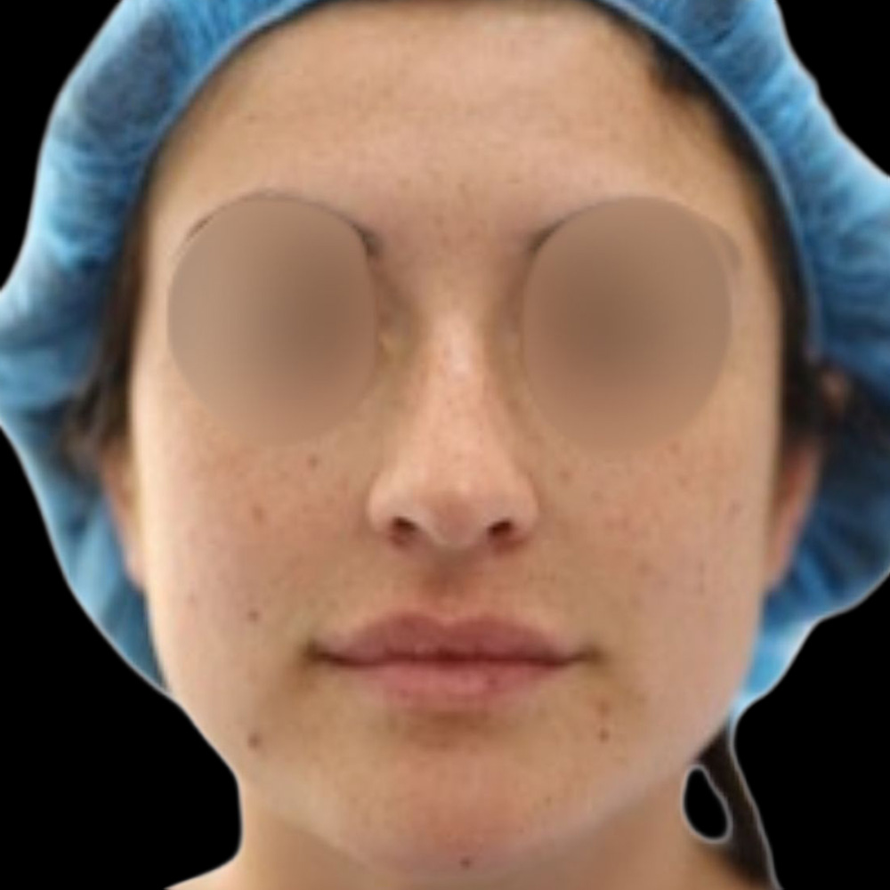 Case--7782 | Before Rhinoplasty 2