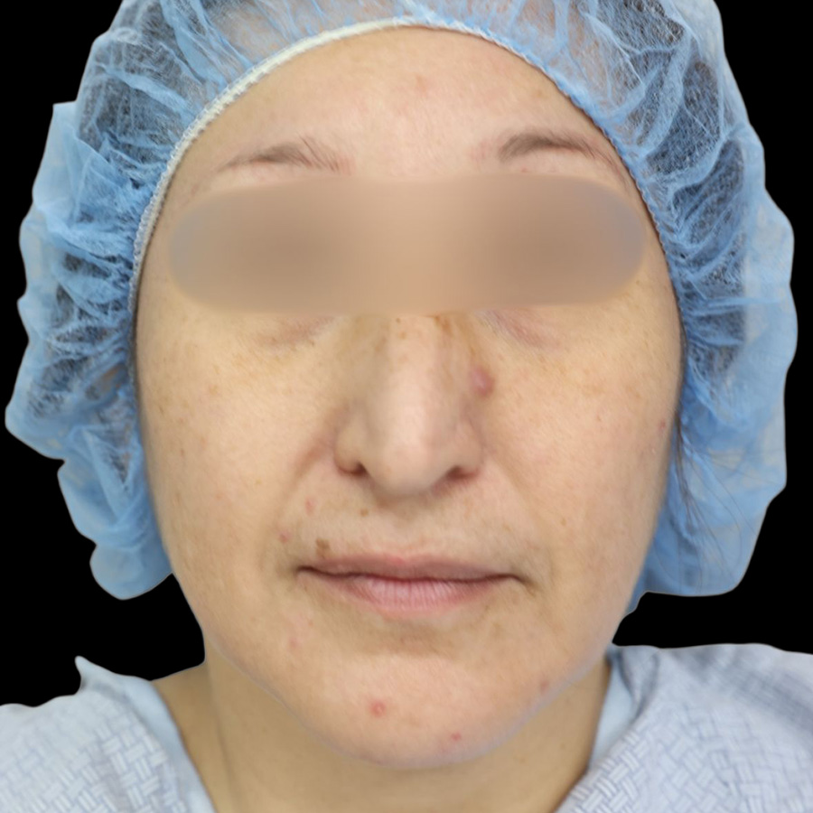 Case--8771 | Before Rhinoplasty 2