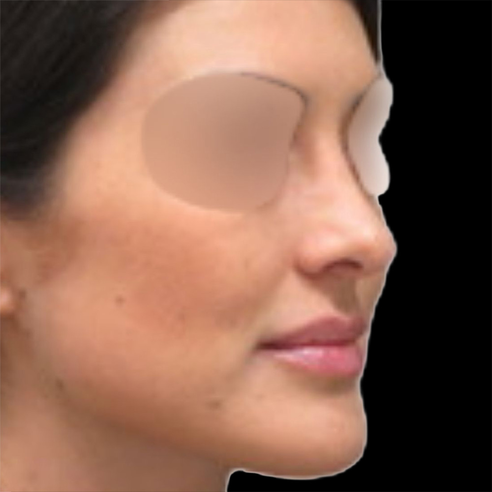 Case--7782 | After Rhinoplasty 3