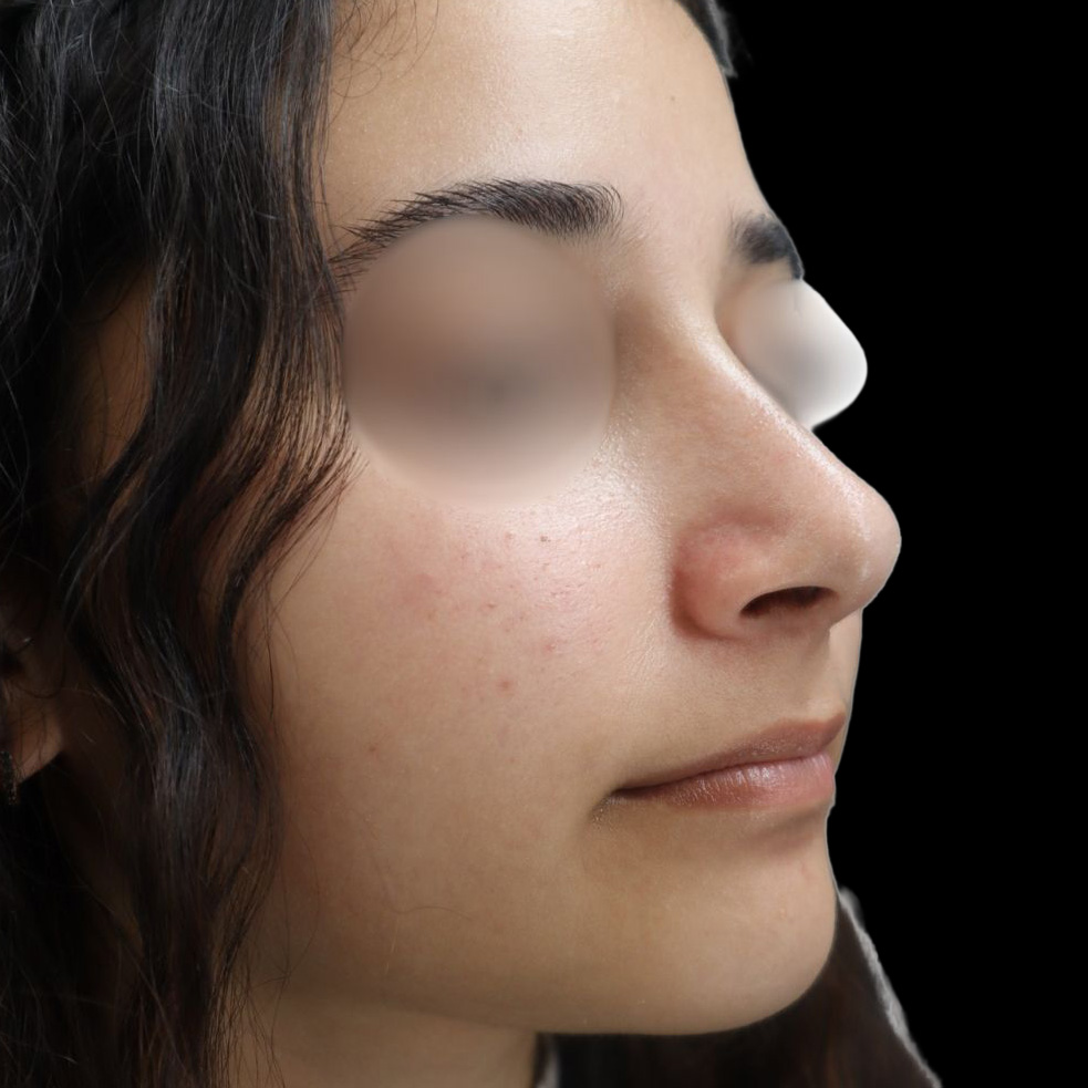 Case--9972 | After Rhinoplasty 3