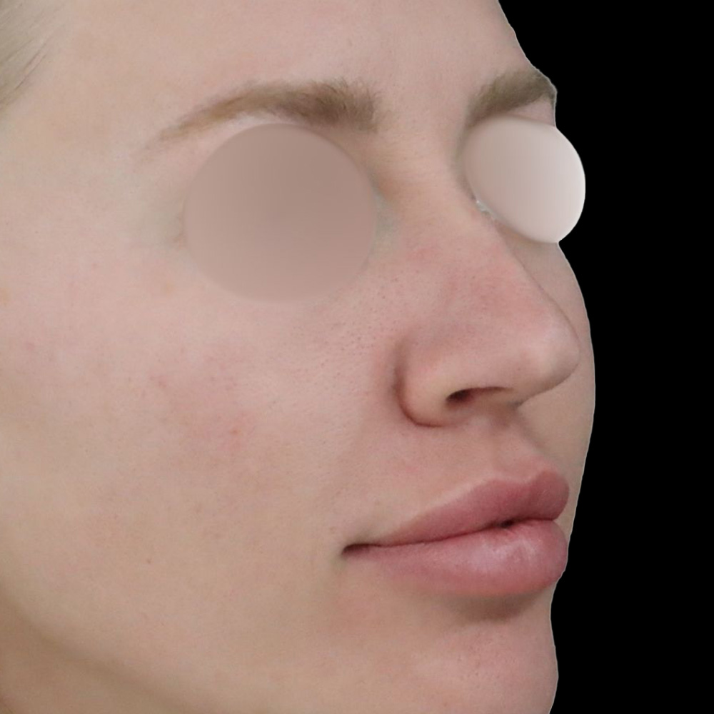 Case--9391 | Before Rhinoplasty 2