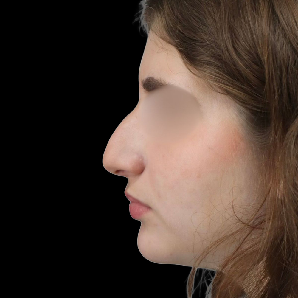 Case--9252 | Before Rhinoplasty
