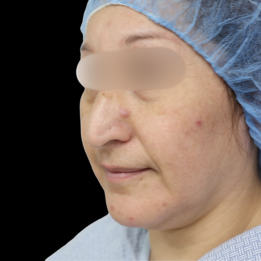 Case--8771 | Before Rhinoplasty 3