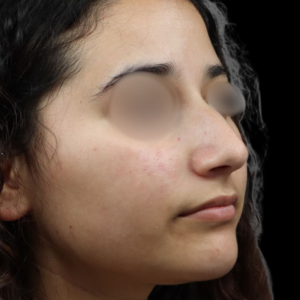 Case--9972 | Before Rhinoplasty 3