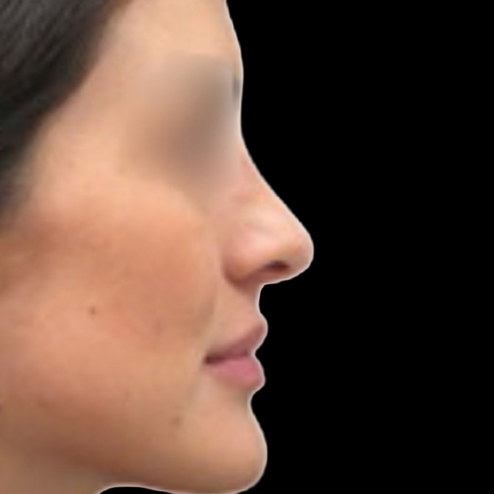 Case--7782 | After Rhinoplasty