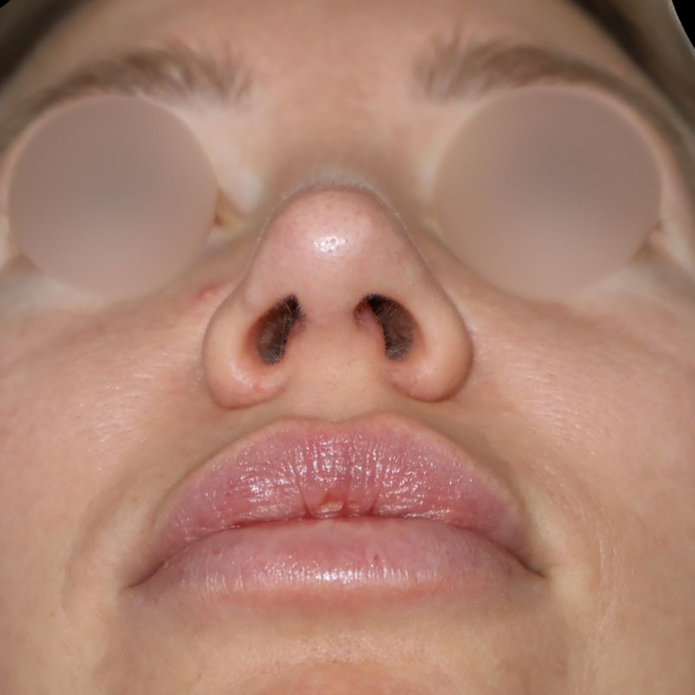 Case--9391 | After Rhinoplasty 3