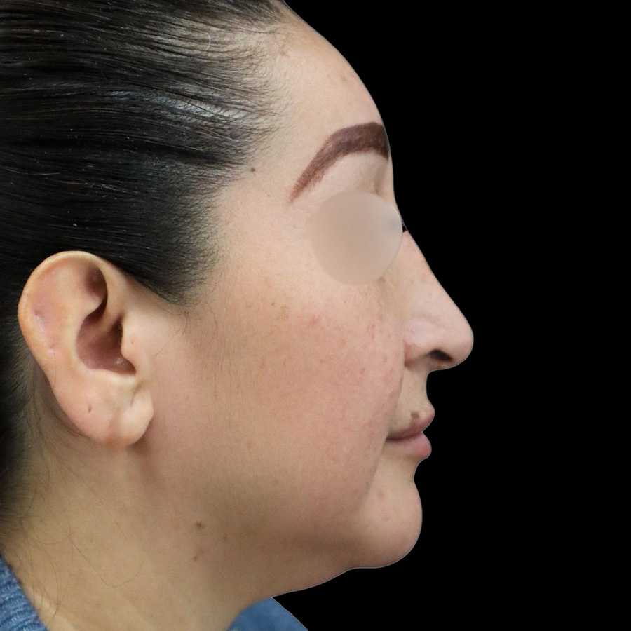 Case--8771 | After Rhinoplasty