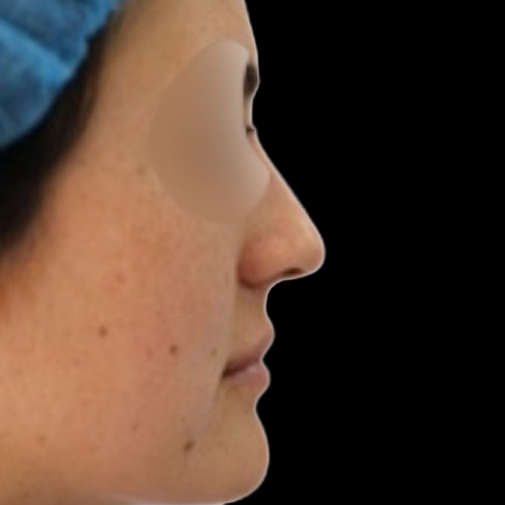 Case--7782 | Before Rhinoplasty