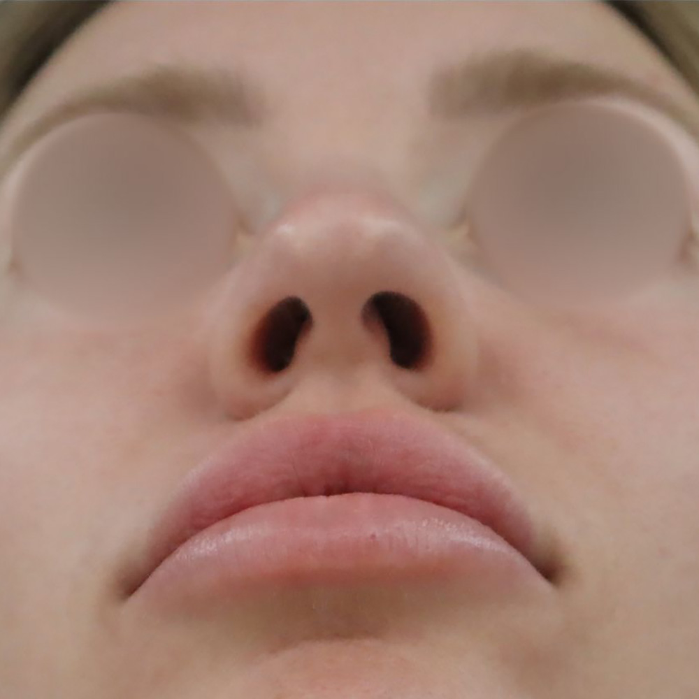 Case--9391 | Before Rhinoplasty 3