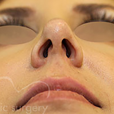 Case--7380 | After Face