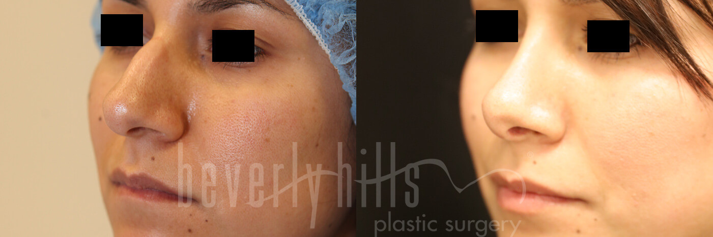 Rhinoplasty Patient 19 Before & After