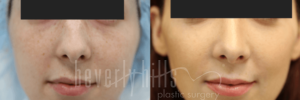 Rhinoplasty Patient 21 Before & After - Thumbnail