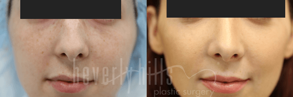 Rhinoplasty Patient 21 Before & After