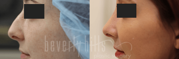 Rhinoplasty Patient 21 Before & After