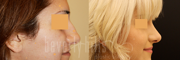 RHINOPLASTY PATIENT 24 Before & After