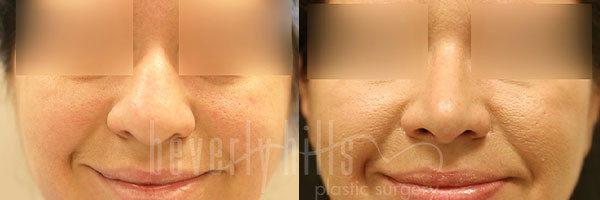 Rhinoplasty Patient 32 Before & After