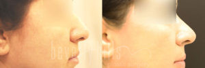 Rhinoplasty Patient 32 Before & After - Thumbnail