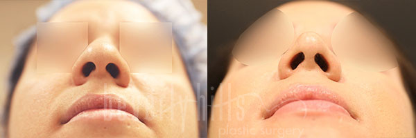 Rhinoplasty Patient 32 Before & After