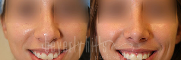 Rhinoplasty Patient 31 Before & After