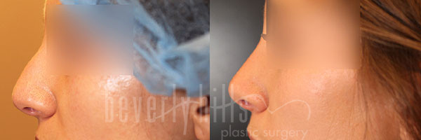 Rhinoplasty Patient 31 Before & After
