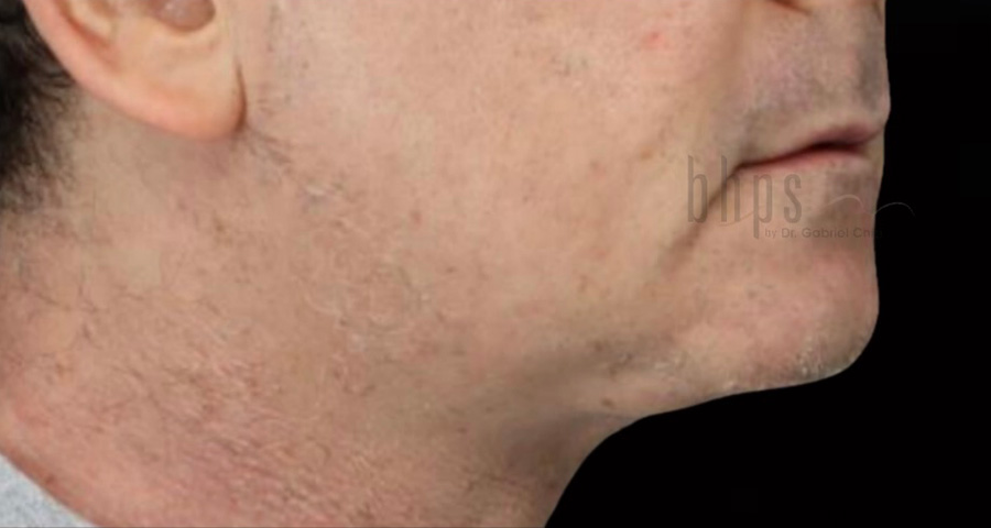 Case--8053 | After SylfirmX 2