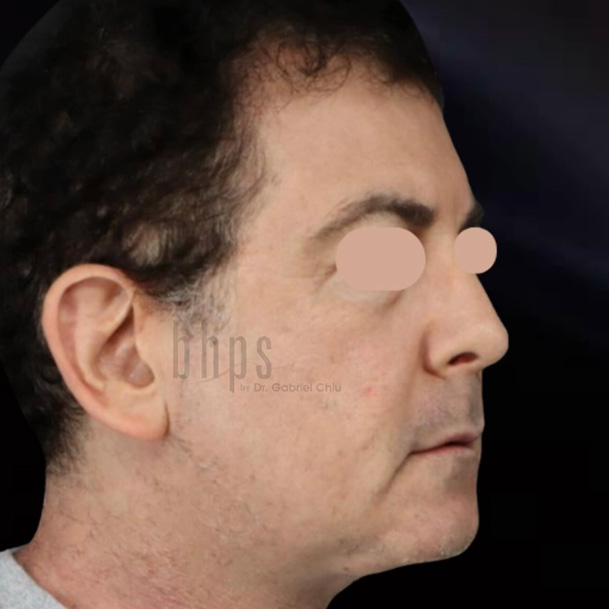 Case--8053 | After SylfirmX