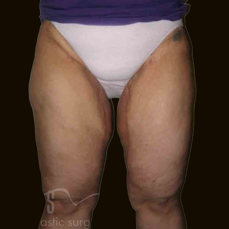 Case--2521 | After Body