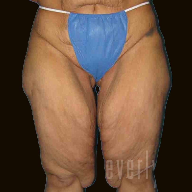 Case--2521 | Before Body