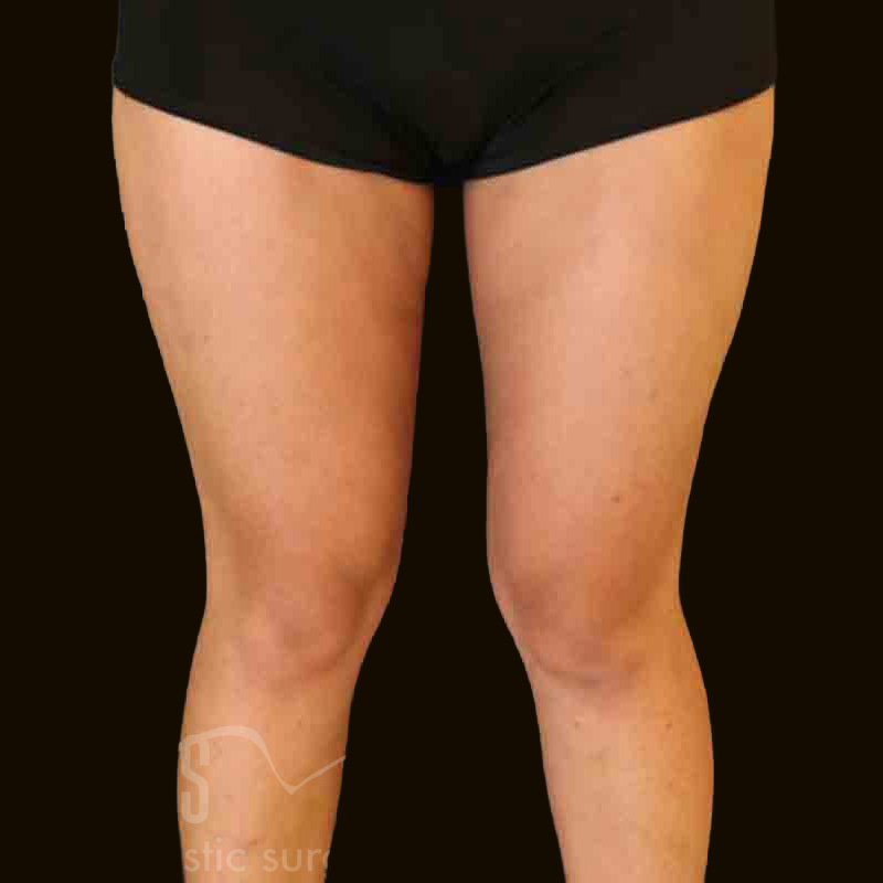 Case--9732 | After Body