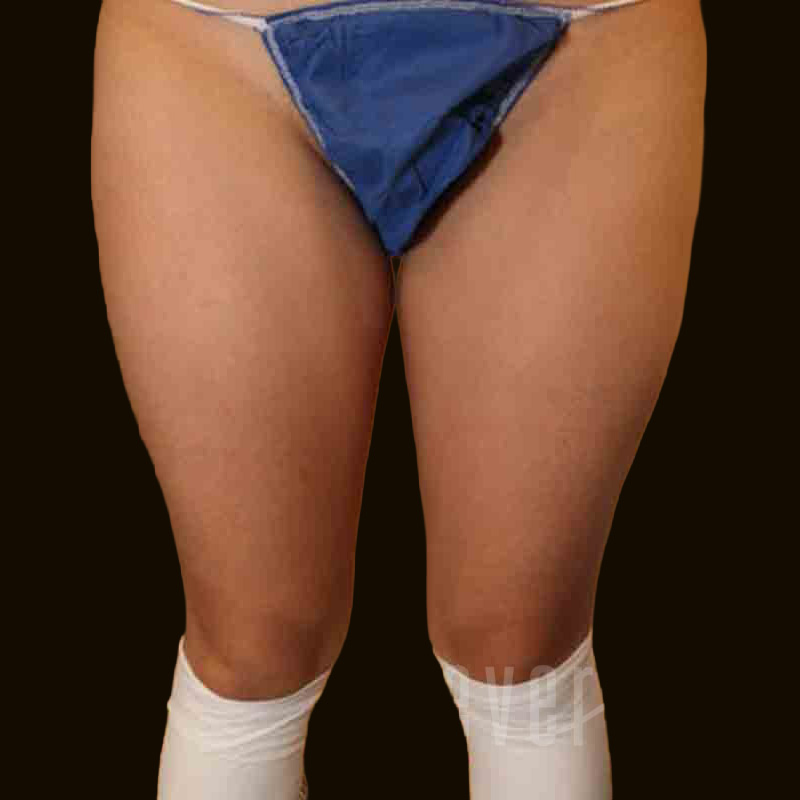 Case--9732 | Before Body