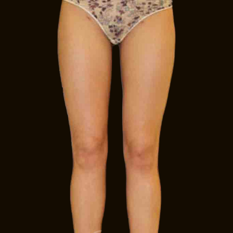 Case--4560 | After Body