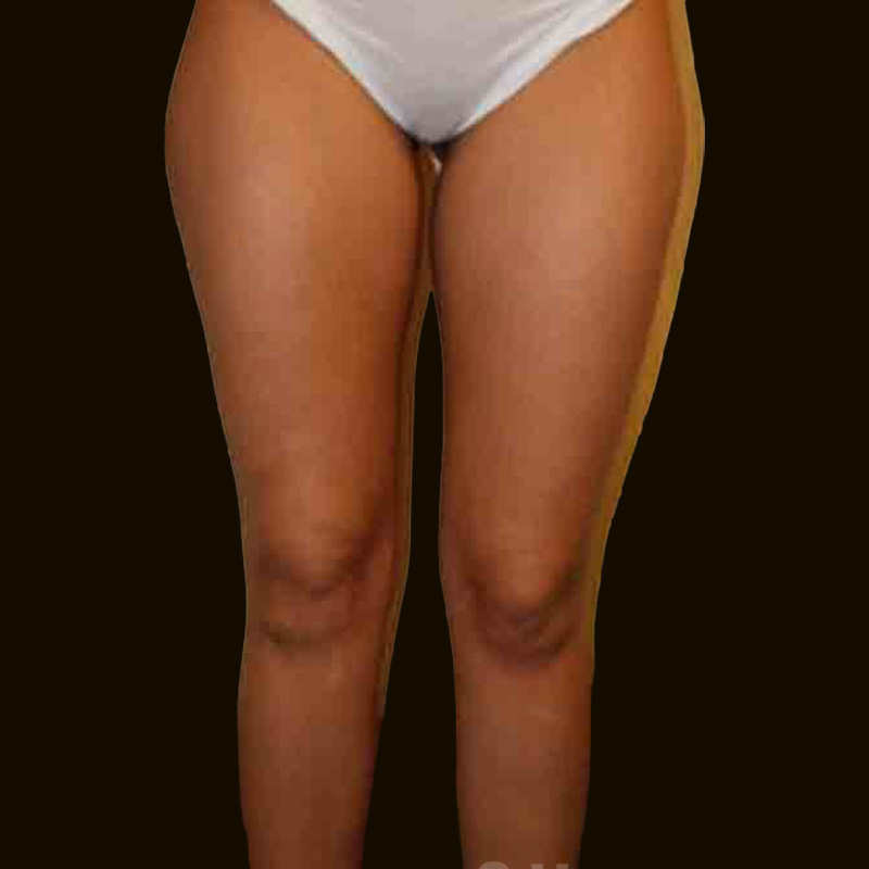 Case--4560 | Before Body