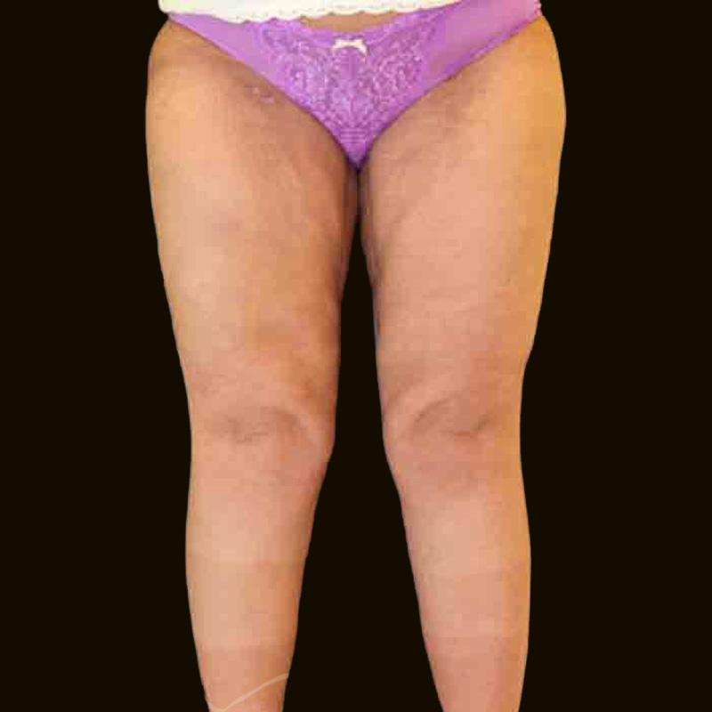 Case--1299 | After Body